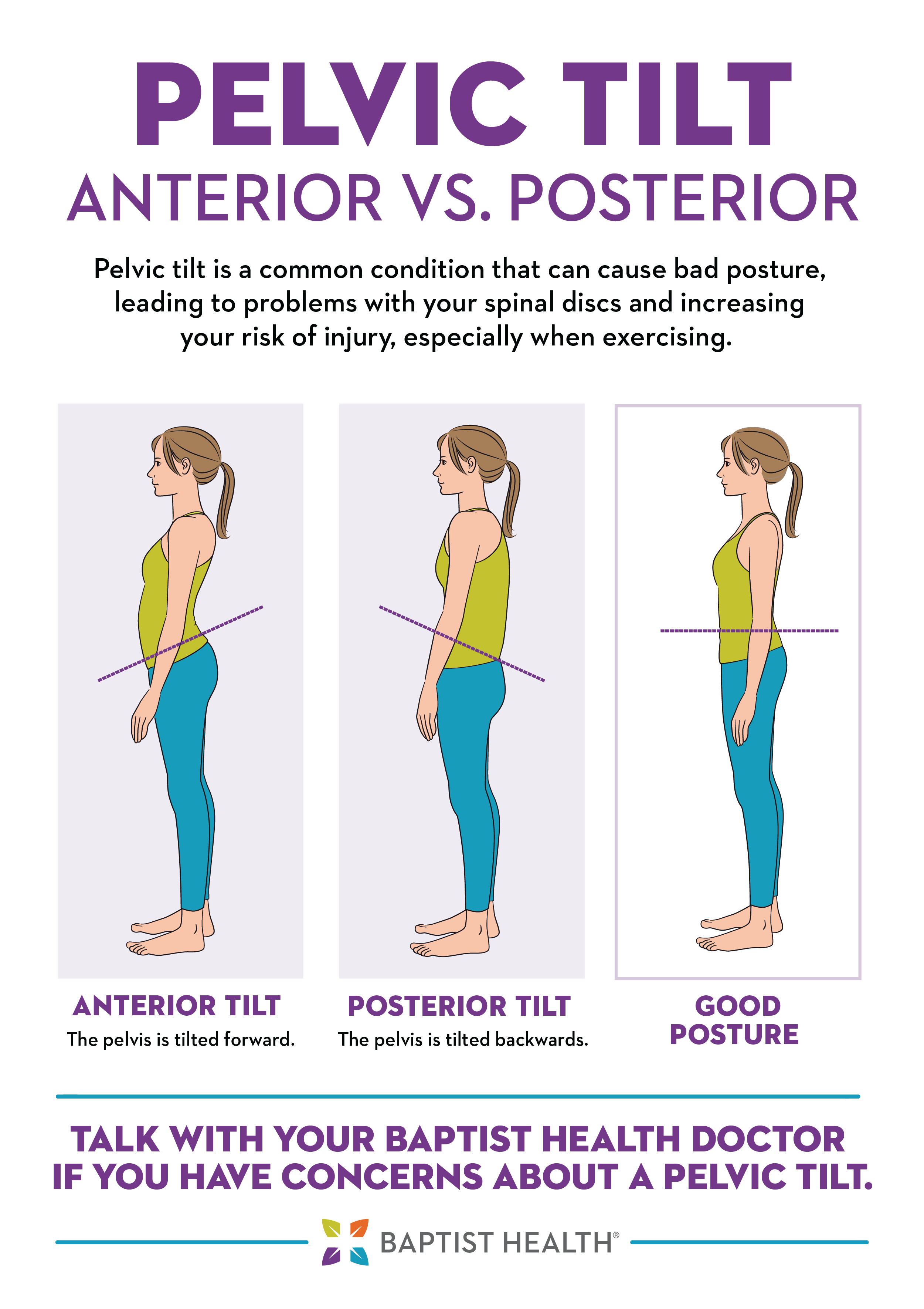 anterior pelvic tilt graphic