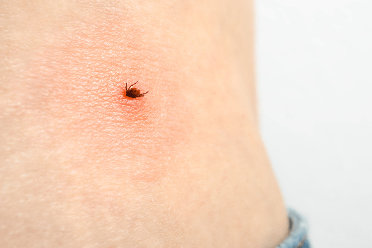 tick bite
