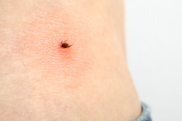 tick bite
