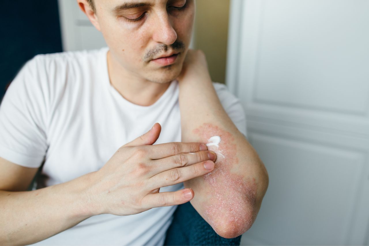 triamcinolone acetonide for eczema