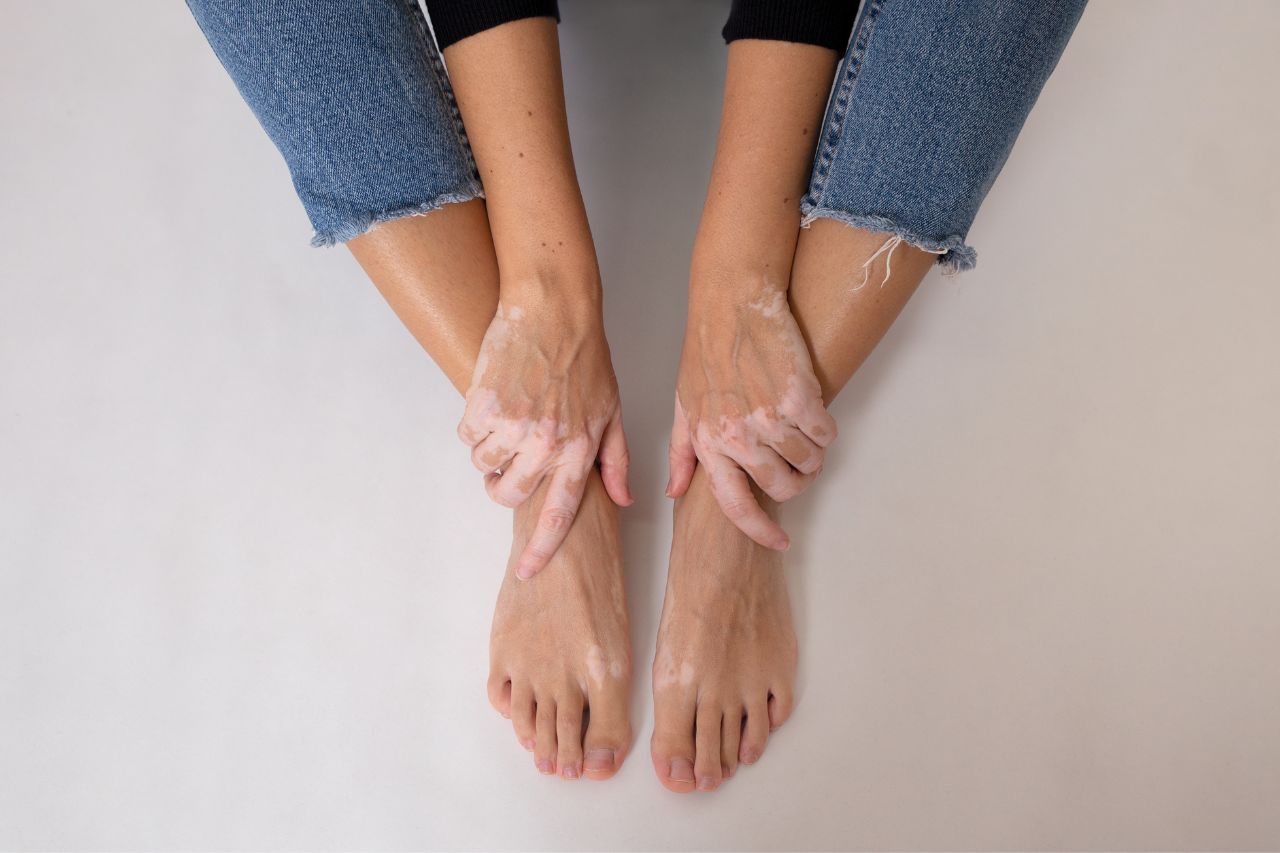vitiligo symptoms